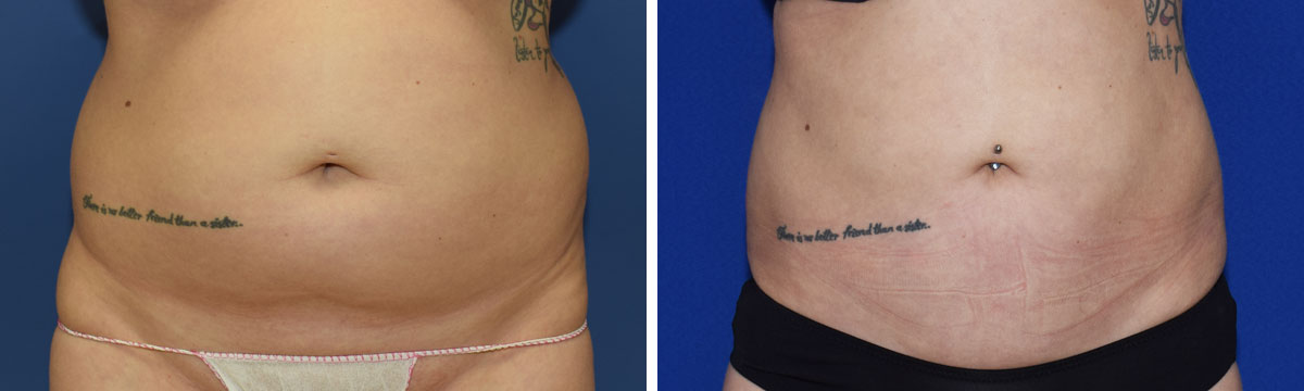 Fettabsaugung am Bauch Perfekter Körper, 1010 Wien