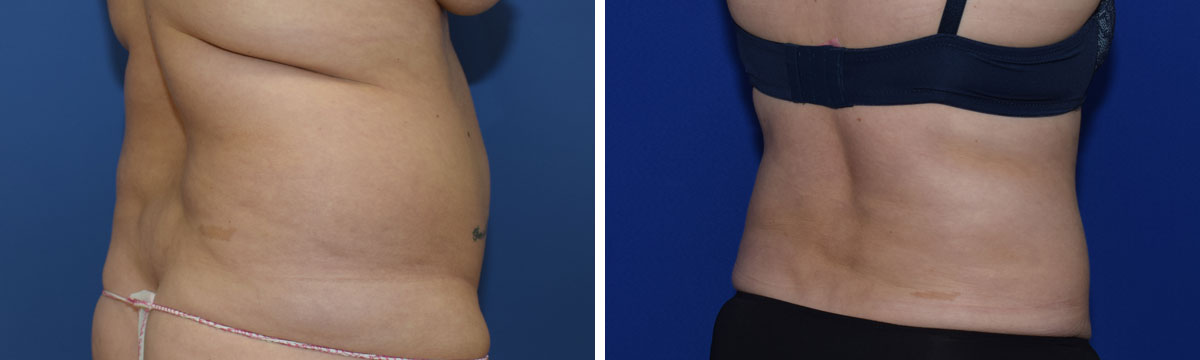 Fettabsaugung am Bauch Perfekter Körper, 1010 Wien