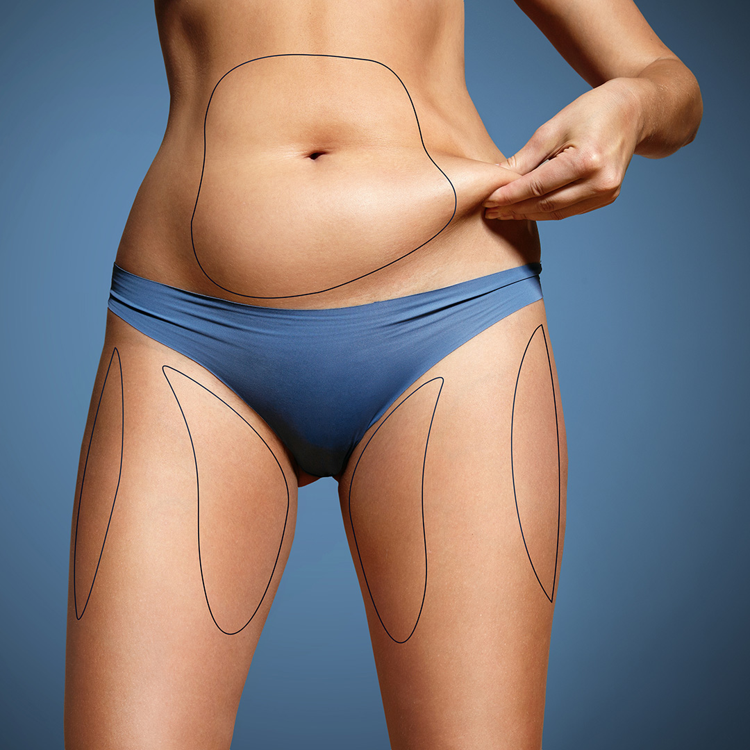 Flanken / Love Handles
