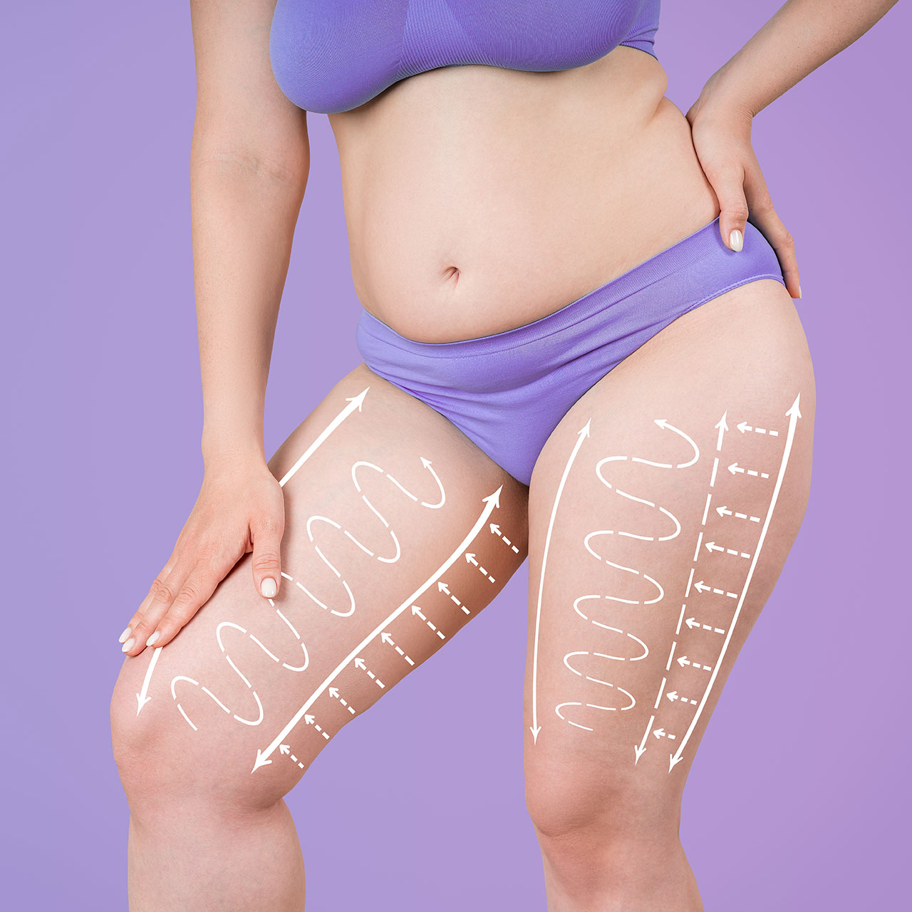 Oberschenkelstraffung (Thigh Lift)