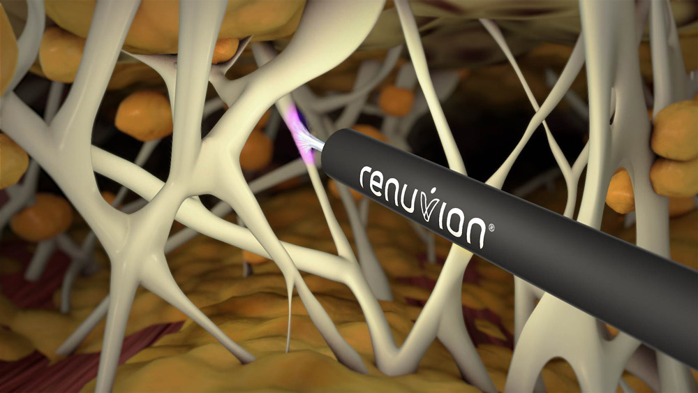 j-Plasma Renuvion® Hautstraffung im Kuzbari Zentrum Wien