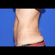 Fettabsaugung, 51 Vorher Nachher