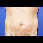 Fettabsaugung, 58 Vorher Nachher