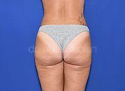 Body Contouring, 26 Vorher Nachher