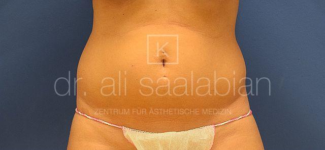 Fettabsaugung, 32 Vorher Nachher