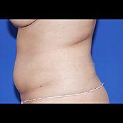 Fettabsaugung, 28 Vorher Nachher