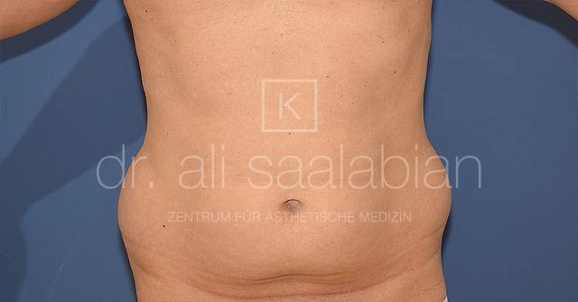 Fettabsaugung, 45 Vorher Nachher