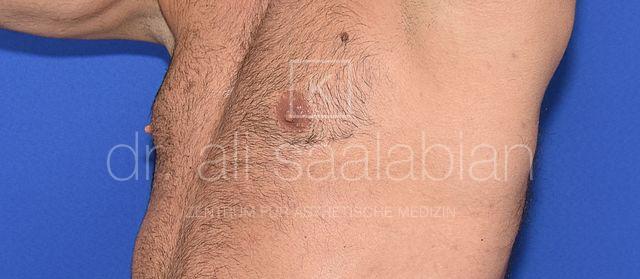 Fettabsaugung, 37 Vorher Nachher