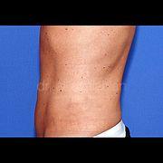 Fettabsaugung, 51 Vorher Nachher