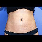 Fettabsaugung, 33 Vorher Nachher