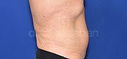 Fettabsaugung, 58 Vorher Nachher