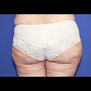 Fettabsaugung, 63 Vorher Nachher