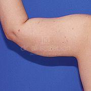 Fettabsaugung, 34 Vorher Nachher