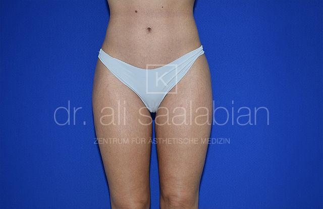 Fettabsaugung, 29 Vorher Nachher
