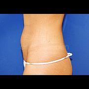 Fettabsaugung, 203 Vorher Nachher