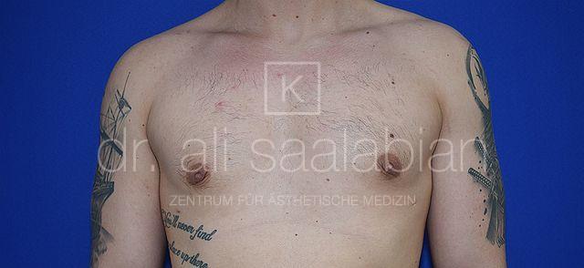 Fettabsaugung, 26 Vorher Nachher