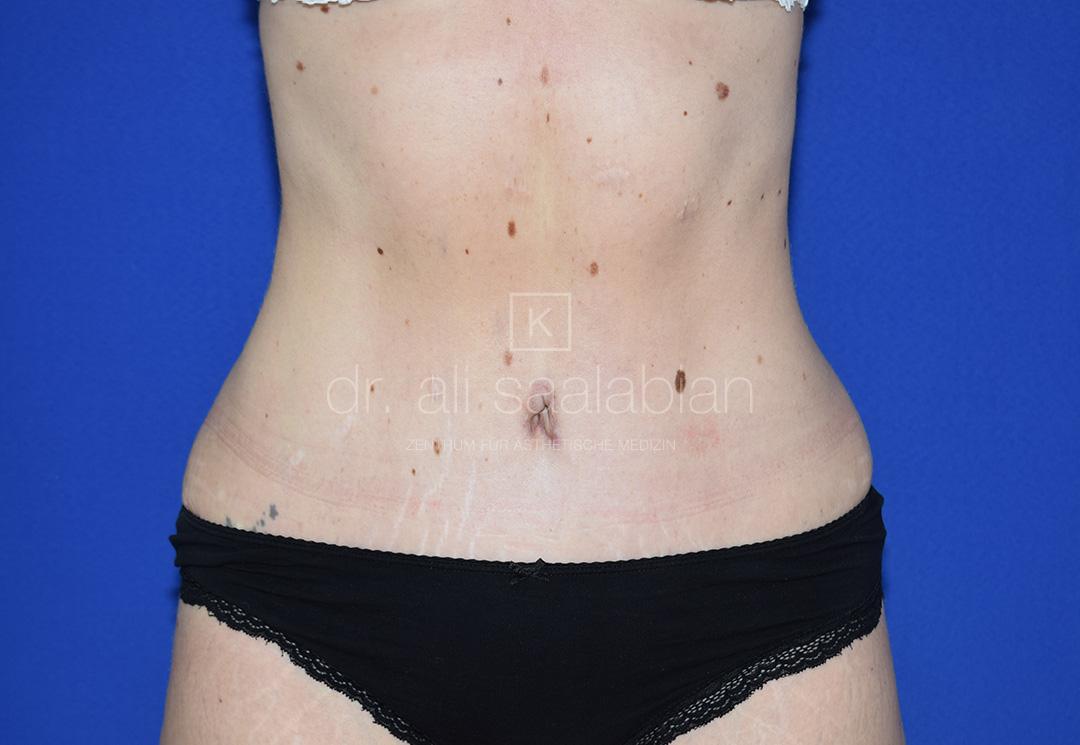 Bauchdeckenstraffung, 33 Vorher Nachher