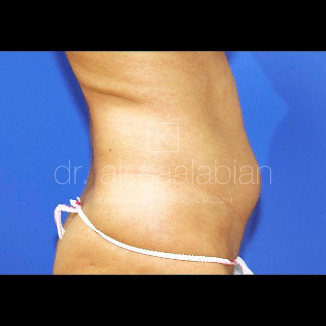 Fettabsaugung, 39 Vorher Nachher