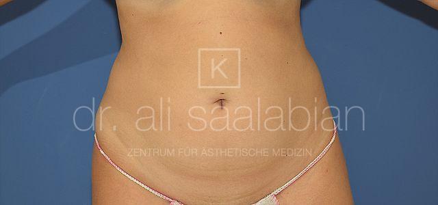 Fettabsaugung, 27 Vorher Nachher