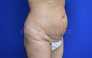 Bauchdeckenstraffung, 52 Vorher Nachher