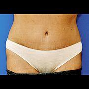 Bauchdeckenstraffung, 50 Vorher Nachher