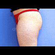 Fettabsaugung, 34 Vorher Nachher