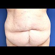 Bauchdeckenstraffung, 59 Vorher Nachher