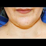 Fettabsaugung, 24 Vorher Nachher