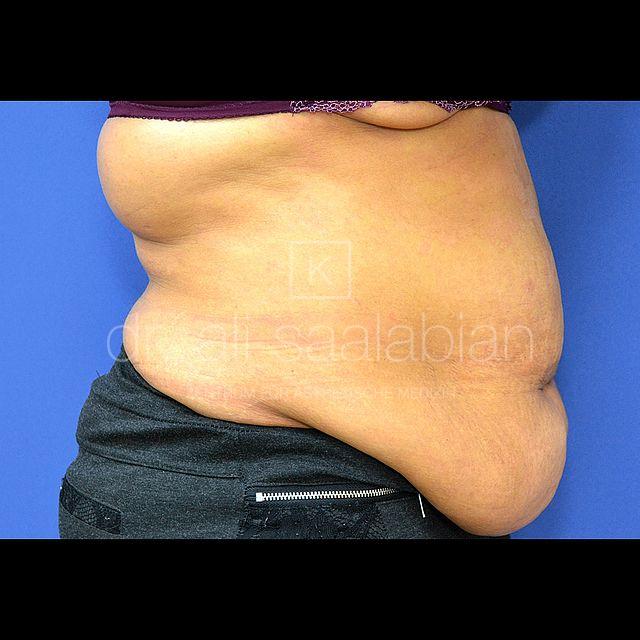 Bauchdeckenstraffung, 43 Vorher Nachher