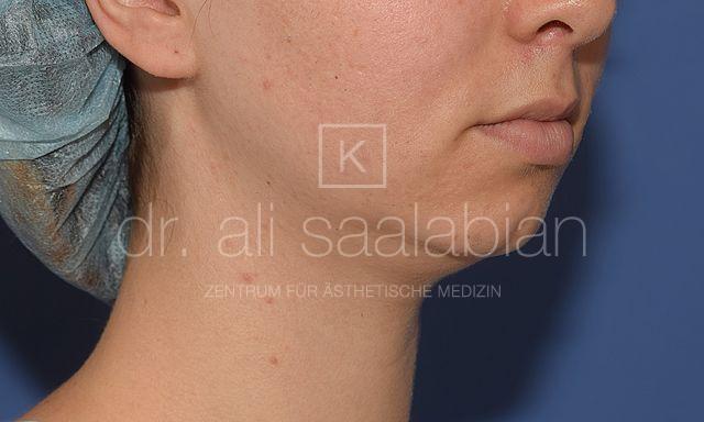 Fettabsaugung, 23 Vorher Nachher