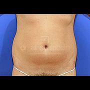 Fettabsaugung, 29 Vorher Nachher