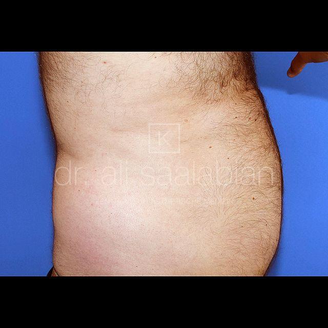 Fettabsaugung, 48 Vorher Nachher