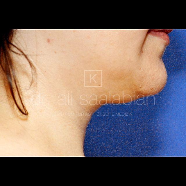 Fettabsaugung, 24 Vorher Nachher