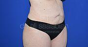 Fettabsaugung, 41 Vorher Nachher