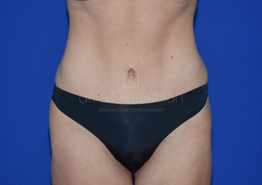 Bauchdeckenstraffung, 38 Vorher Nachher