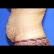 Bauchdeckenstraffung, 51 Vorher Nachher