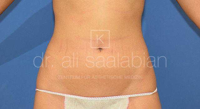 Fettabsaugung, 23 Vorher Nachher