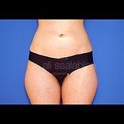 Fettabsaugung, 33 Vorher Nachher