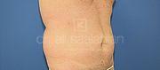 Fettabsaugung, 58 Vorher Nachher