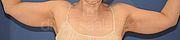 Fettabsaugung, 43 Vorher Nachher