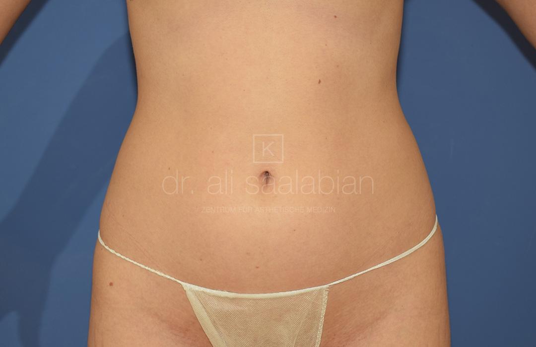 Fettabsaugung, 23 Vorher Nachher