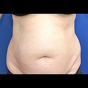 Bauchdeckenstraffung, 47 Vorher Nachher