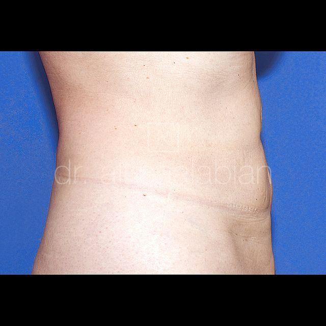 Fettabsaugung, 62 Vorher Nachher