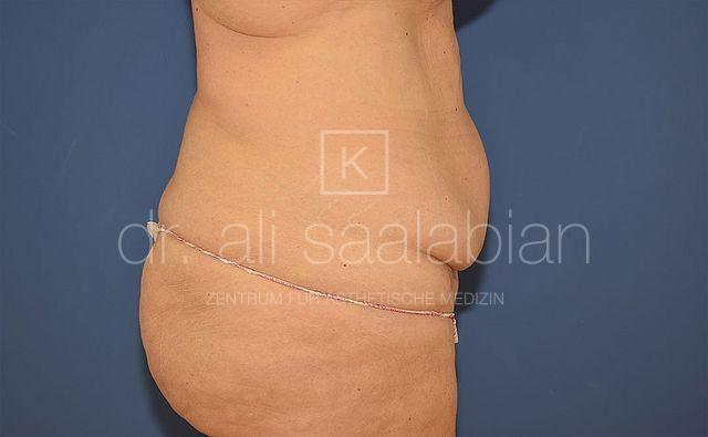 Bauchdeckenstraffung, 46 Vorher Nachher