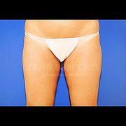 Fettabsaugung, 42 Vorher Nachher