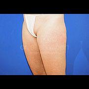 Fettabsaugung, 26 Vorher Nachher