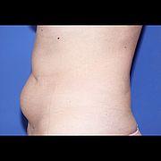 Fettabsaugung, 62 Vorher Nachher