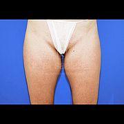 Fettabsaugung, 26 Vorher Nachher