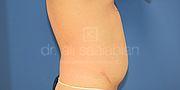 Fettabsaugung, 40 Vorher Nachher