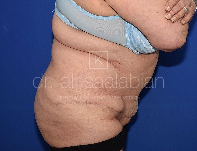 Bauchdeckenstraffung, 62 Vorher Nachher